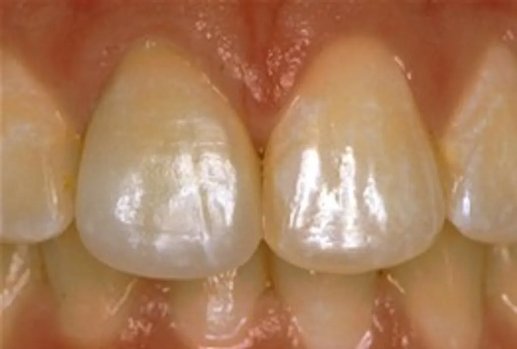 After: A Front Tooth Made Whole Again