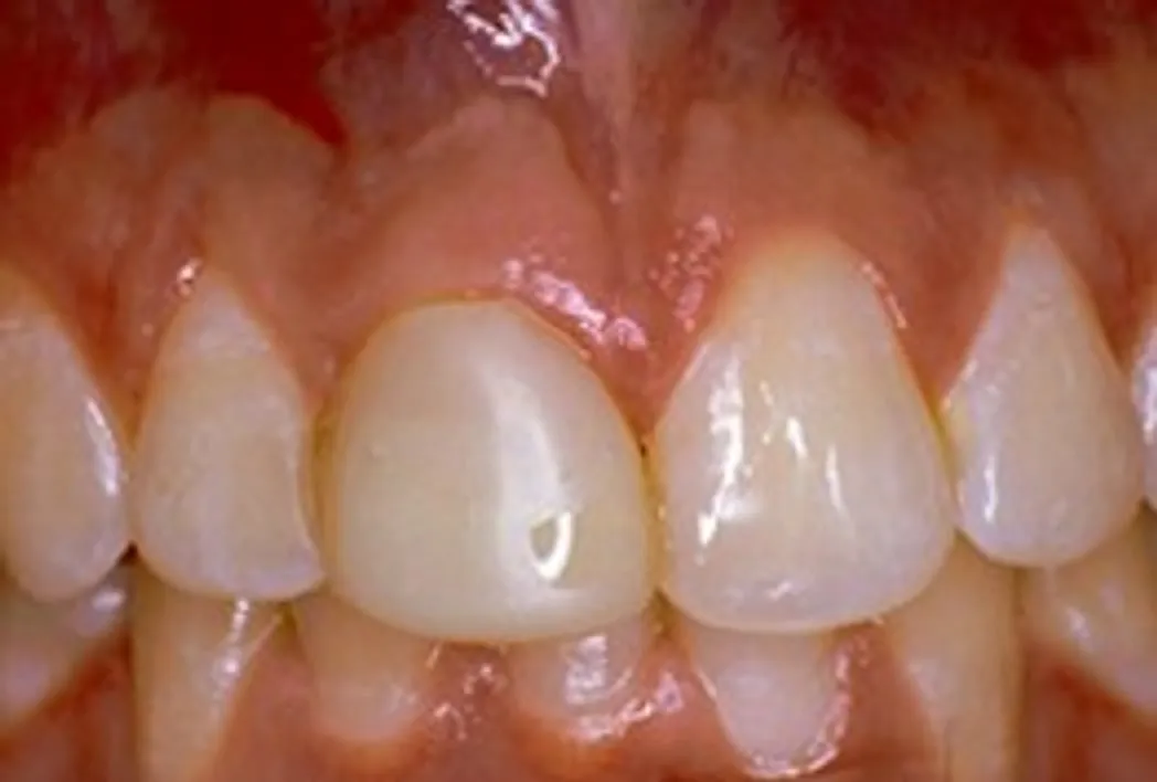Before: A Front Tooth Made Whole Again