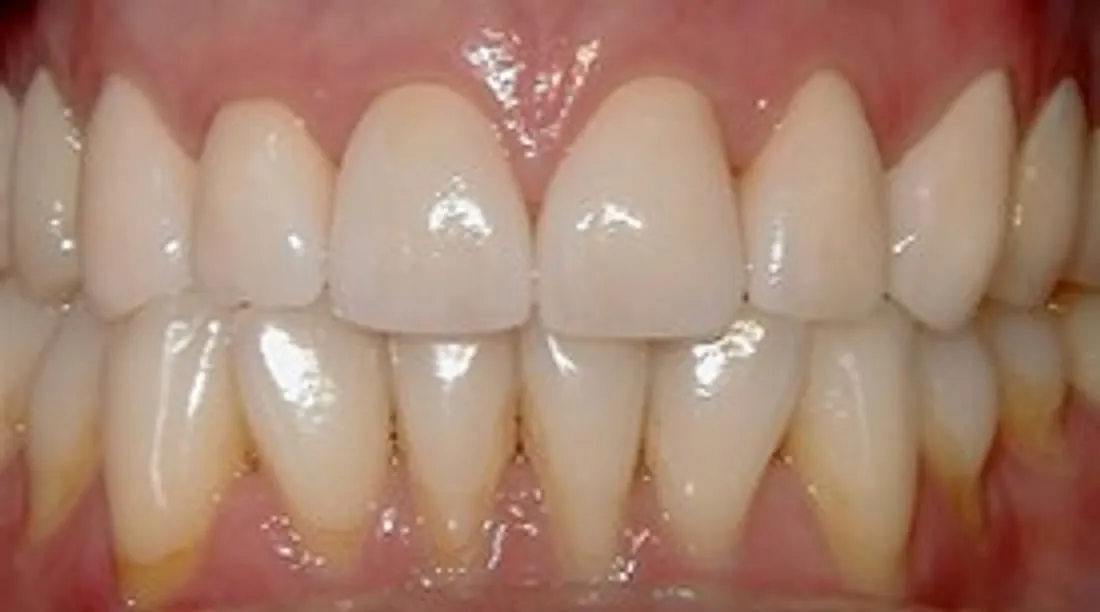 Smile after eight upper all-porcelain crowns