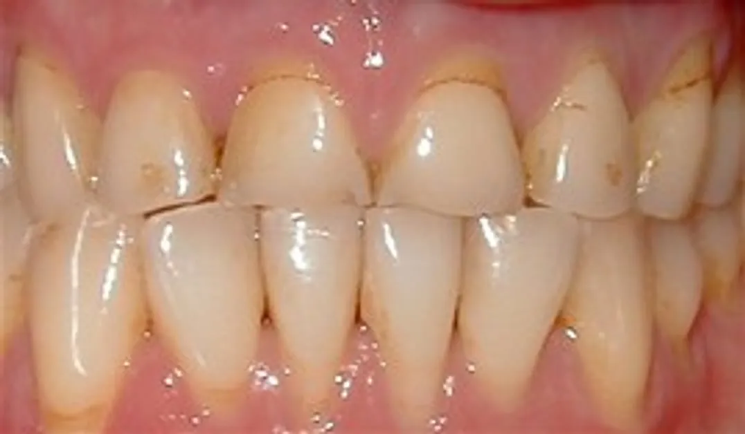 Smile before upper arch rehabilitation