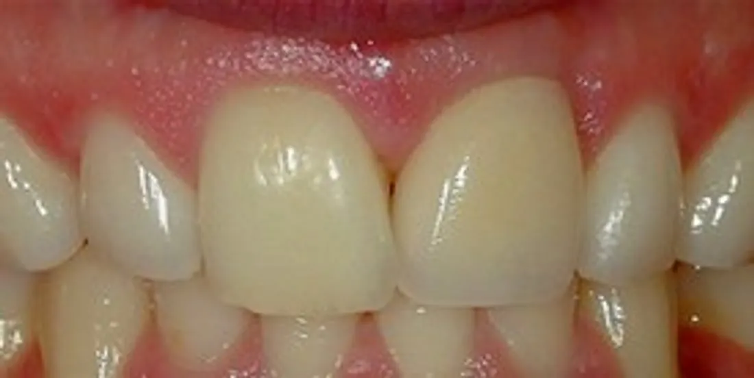 After: One Missing Front Tooth, Seamlessly Replaced