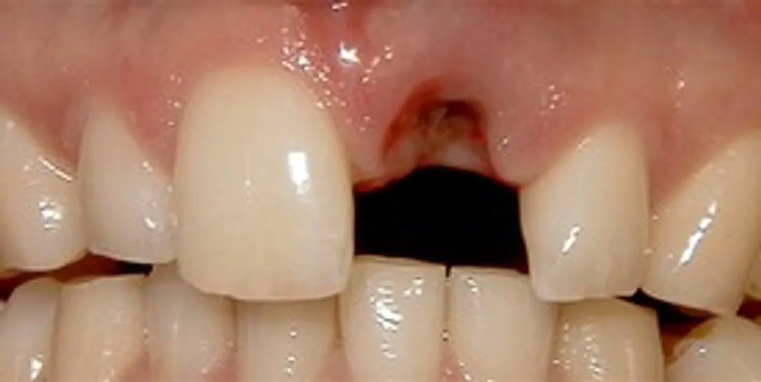 Before: One Missing Front Tooth, Seamlessly Replaced