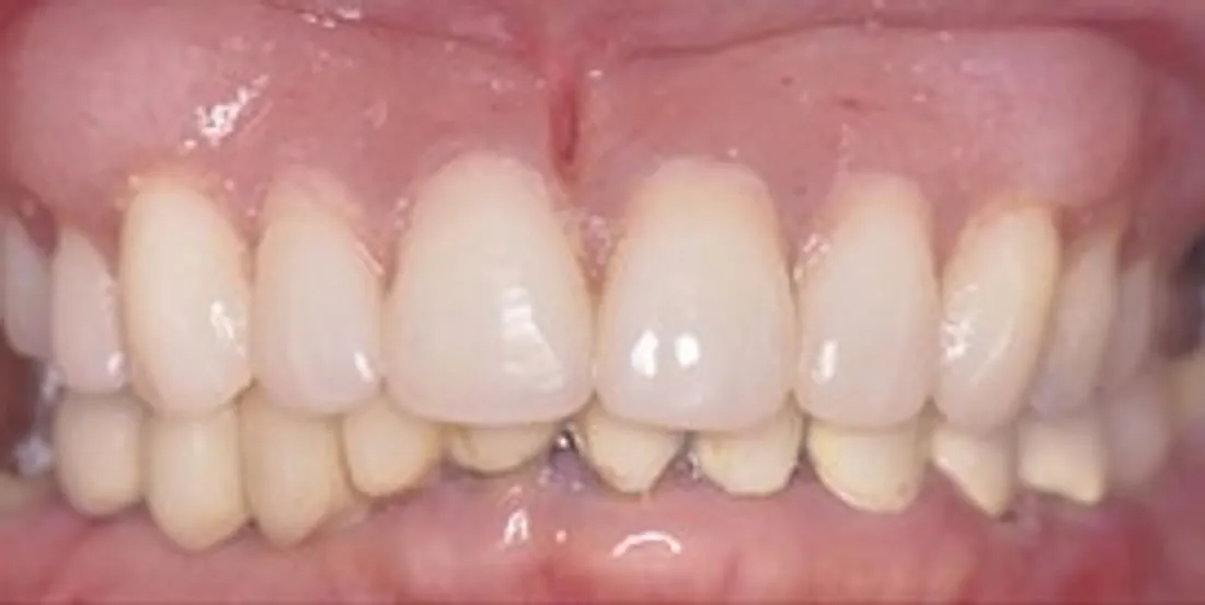 After: A Full-Mouth Rehabilitation with Implants