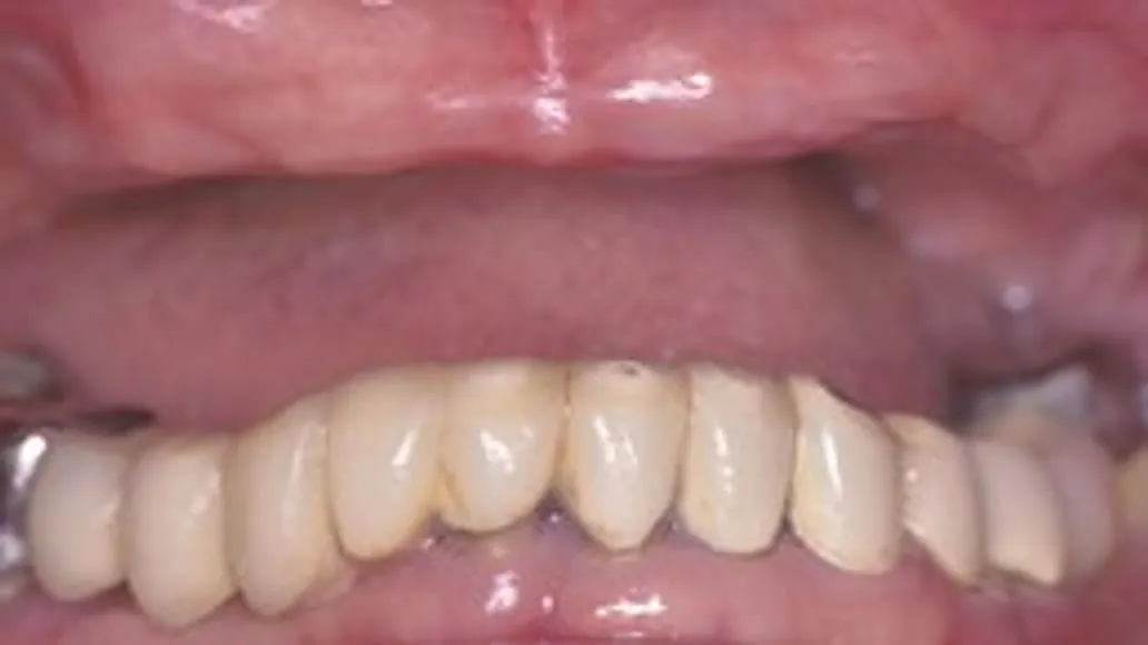 Before: A Full-Mouth Rehabilitation with Implants