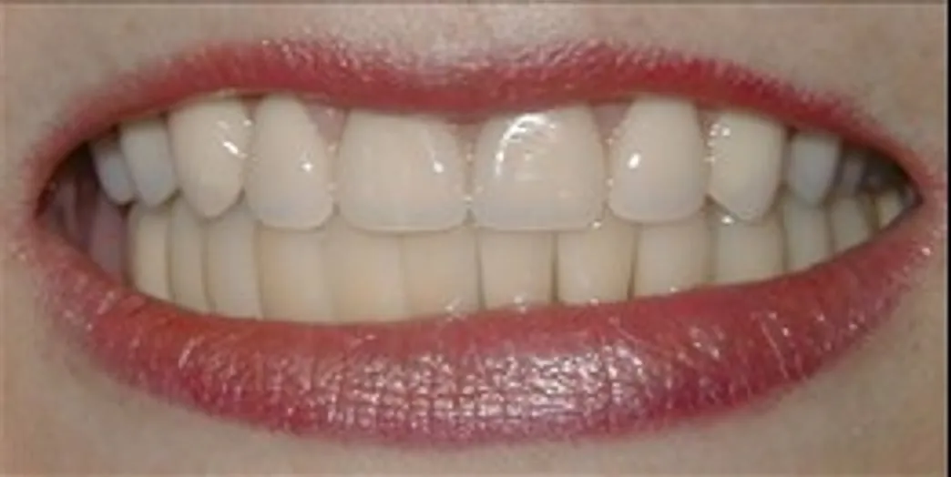 After: Implants and Crowns for a Second Full-Arch Story