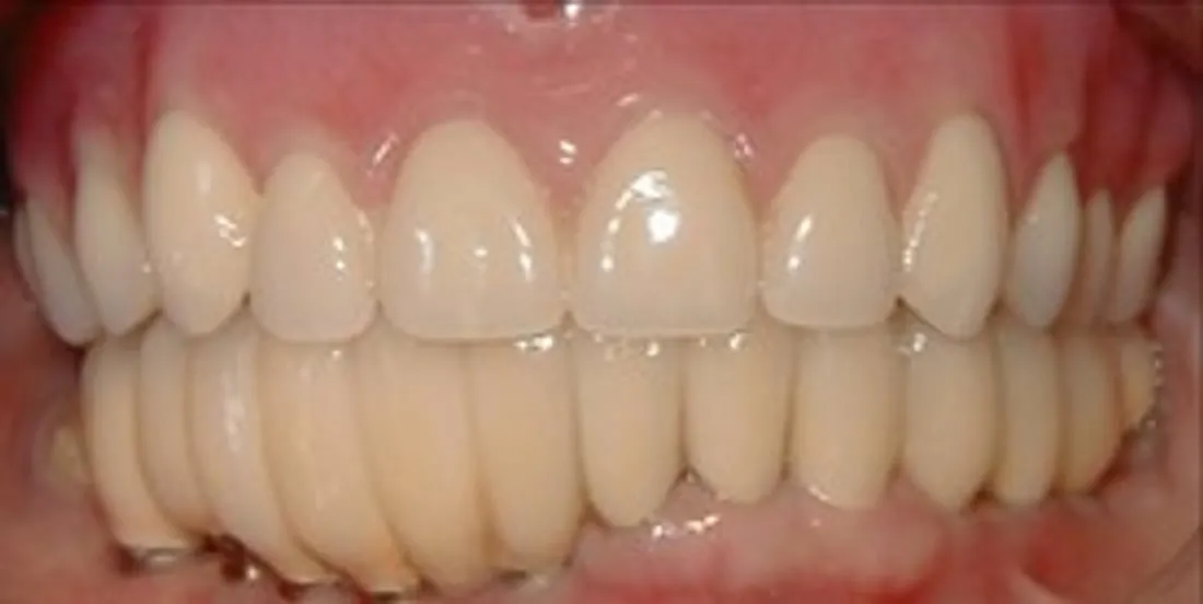Before: Implants and Crowns for a Second Full-Arch Story